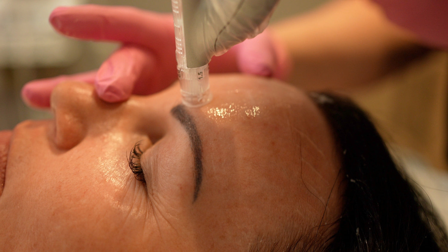 The Rise of Microneedling and RF Microneedling in Skin Rejuvenation