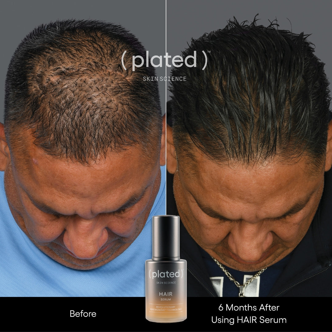 Before and After Plated Hair Serum- Male Hair Thinning