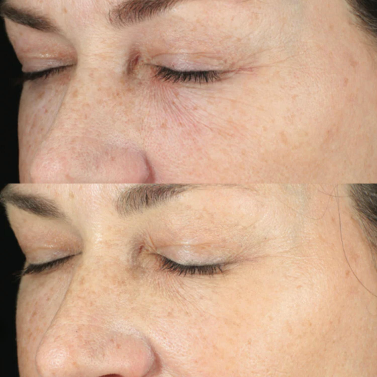 Before and After using Hydrinity Retaxome Retinal Daily Hydrator