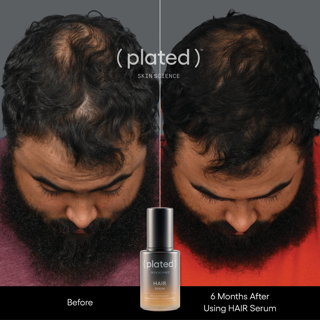 Before and After Picture of Man after using Plated Hair Serum- Mail Hair Thinning At The Crown 