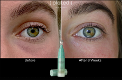 Before and after comparison of eye treatment with a product shown.